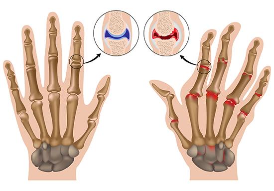 artros i fingrarna symtom